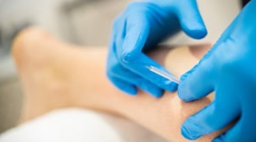 DRY NEEDLING