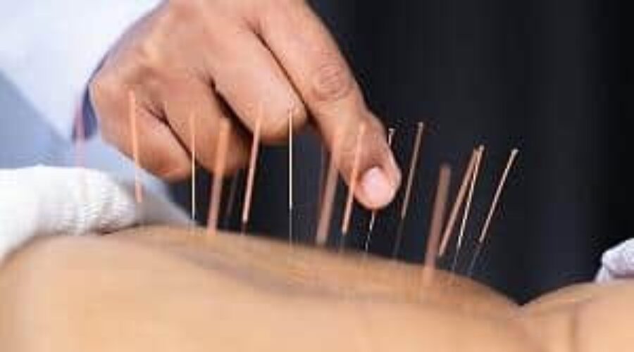 Acupuncture in Holistic Healthcare