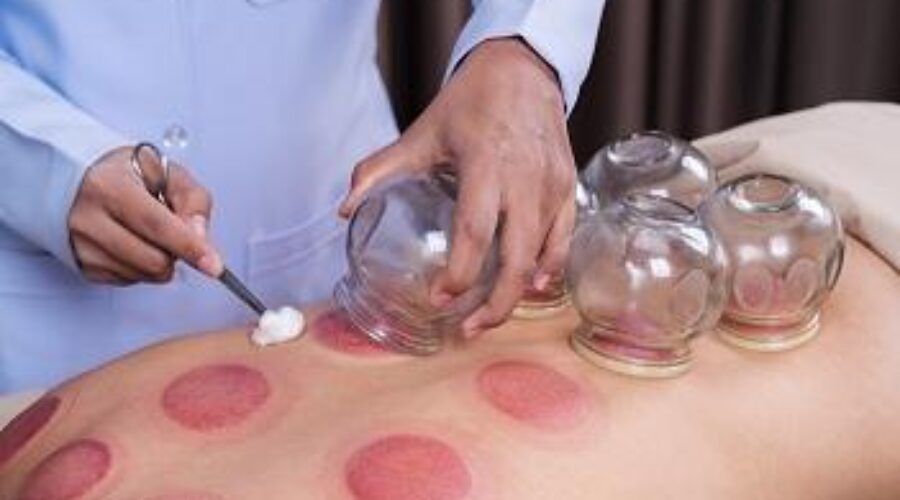 What is Cupping?