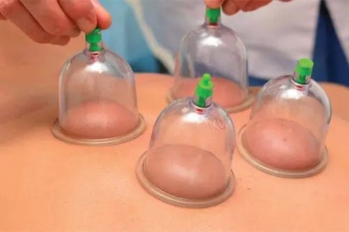 Cupping Healing for Better Circulation